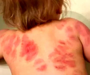Fue a buscar a su hija a la guardería y se percató que tenía el cuerpo lleno de mordeduras