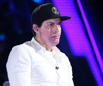 Ignacio Lastra subió su primera selfie tras accidente mostrando su recuperación