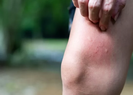 Que Hacer En Caso De Picadura