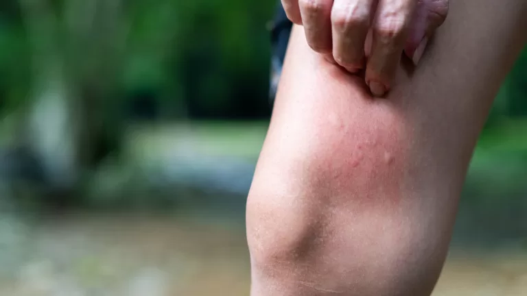 Que Hacer En Caso De Picadura