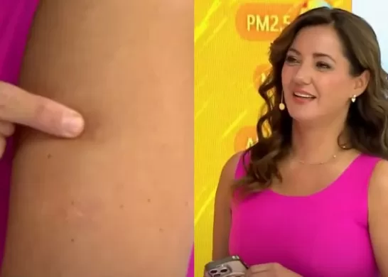 Priscilla Vargas Tumor Brazo