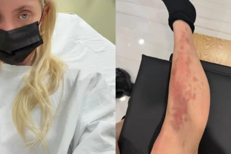 Taylor Momsen Sufre Picadura De Araña