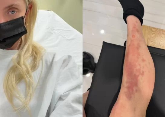 Taylor Momsen Sufre Picadura De Araña