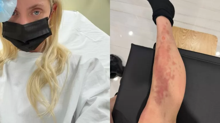 Taylor Momsen Sufre Picadura De Araña